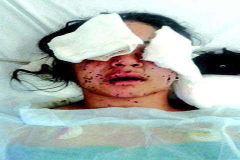 33 Korban Peluru Pelet di Kashmir Alami Kebutaan