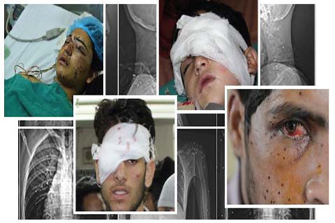 Transplantasi Mata Tidak Bisa Bantu Semua Korban Pelet di Kashmir