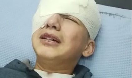 Mata Kanan Anak Palestina Ditembak Tentara Israel